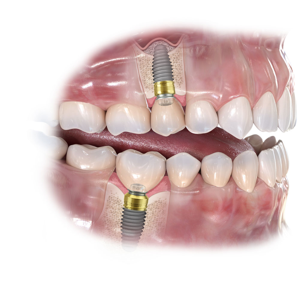 ImplantatiSlika3